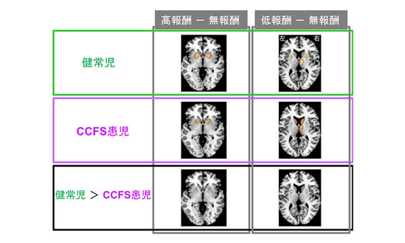 報酬獲得時の線条体のfMRI画像