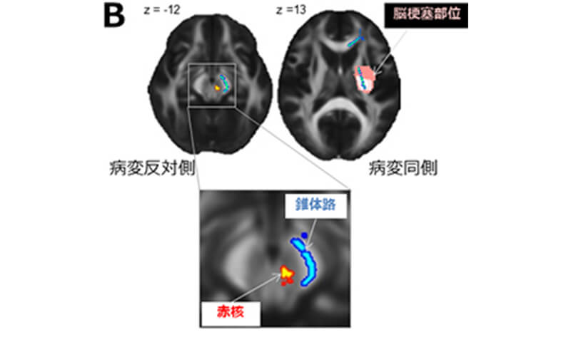 脳卒中発症後の脳内の拡散テンソル画像の変化  